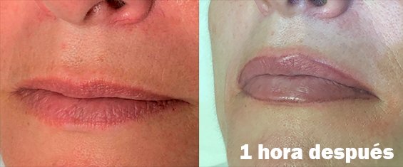 Micropigmentación de Labios 1 hora después